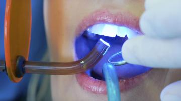 Разновидности пломб в стоматологии